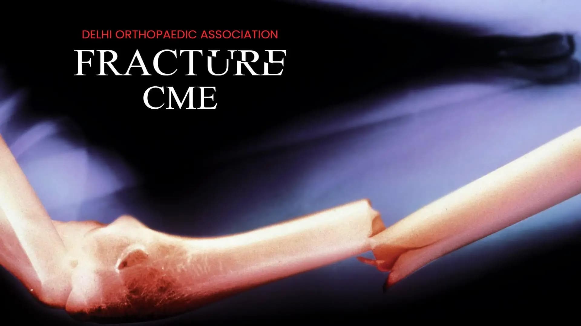 Delhi Orthopaedic Association - Fracture CME