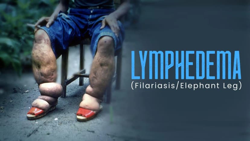 Management of Lymphedema