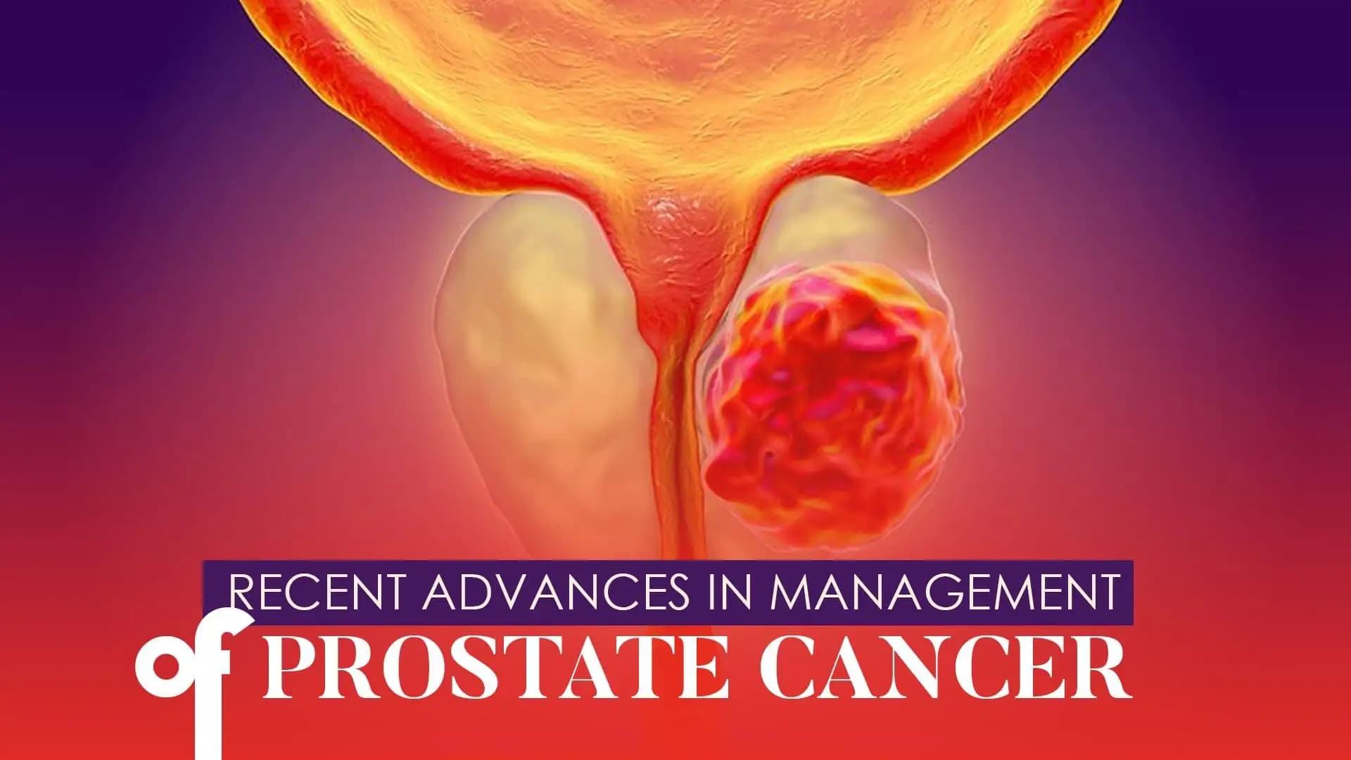 Recent Advances in Management of Prostate Cancer