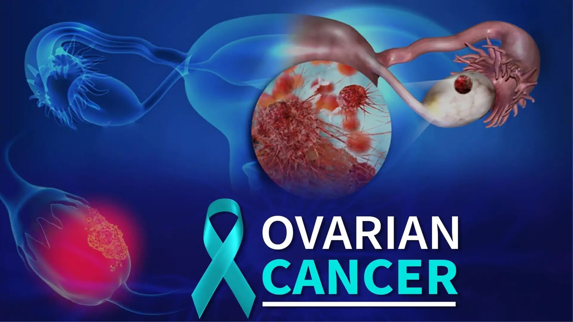 Ovarian Cancer