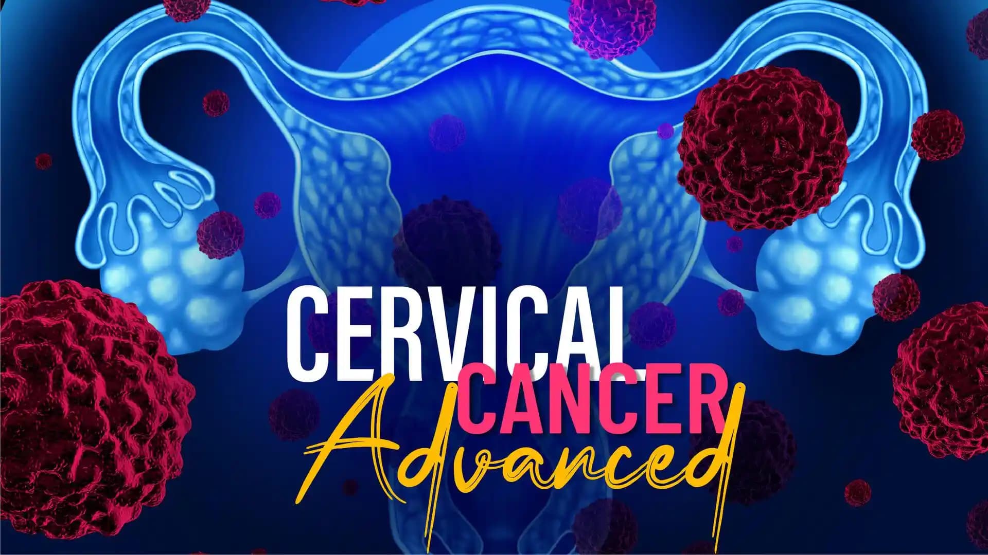 Cervical Cancer Advanced