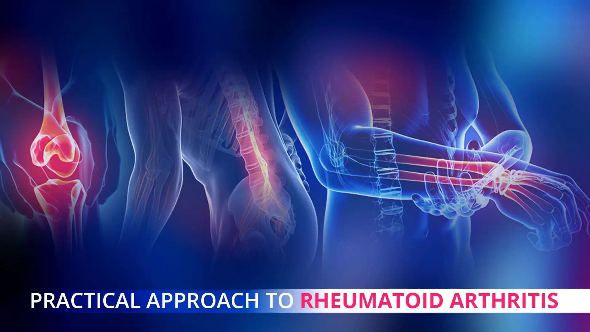 Right Therapy at the Right Time: Practical Approach to Rheumatoid Arthritis