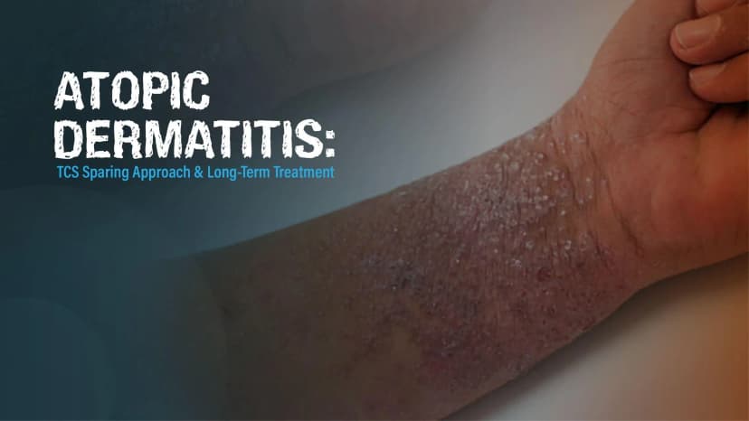 Atopic Dermatitis: TCS Sparing Approach and Long-Term Treatment