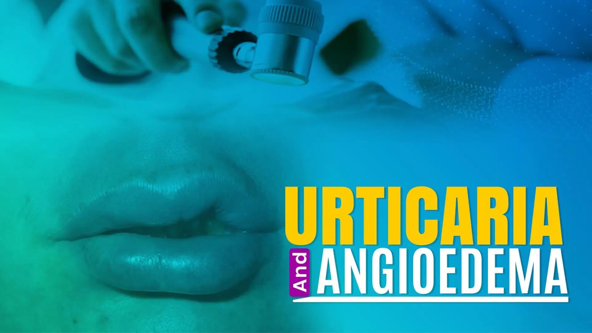 Urticaria and Angioedema