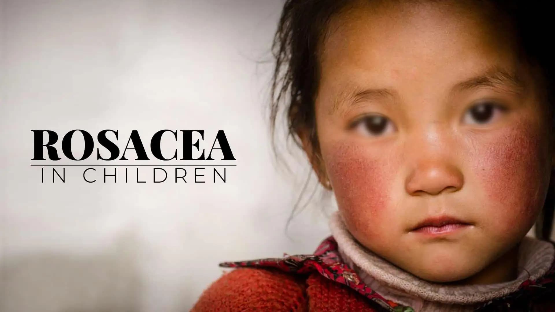 Rosacea in Children