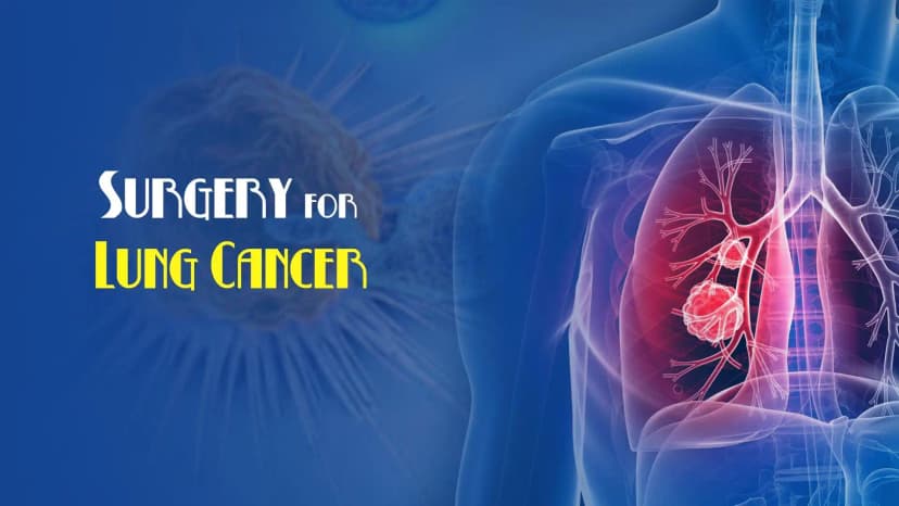 Surgery for Lung Cancer