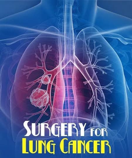 Surgery for Lung Cancer