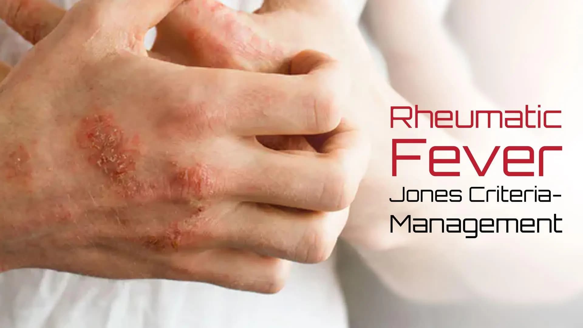 Rheumatic Fever-Jones Criteria: Management