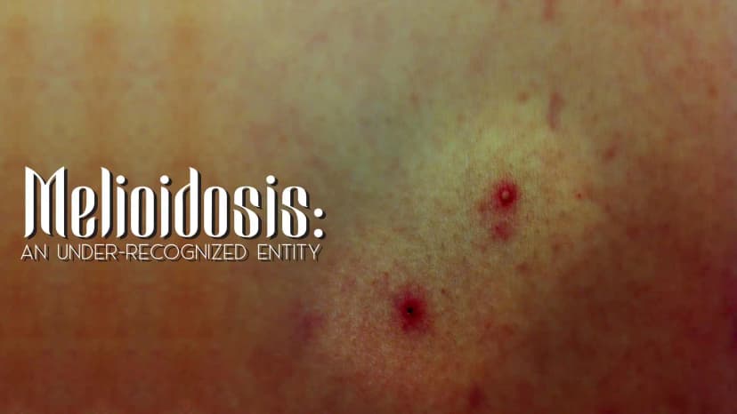 Melioidosis: An Under-Recognized Entity