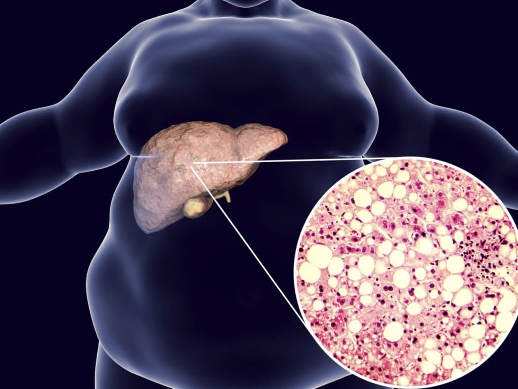 Association of fatty liver with pulmonary nodules