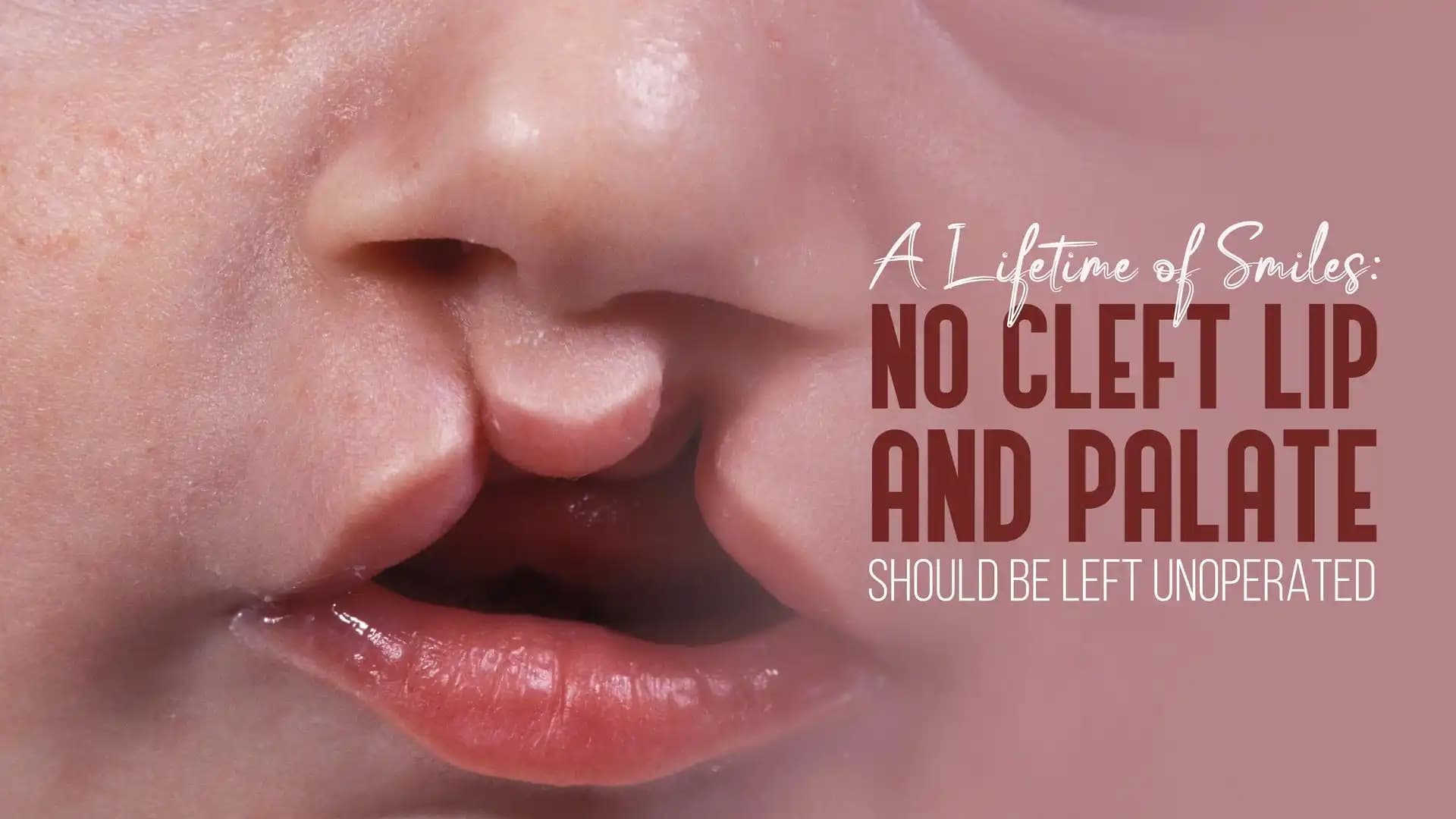 A lifetime of Smiles: No Cleft Lip and Palate should be Left Unoperated