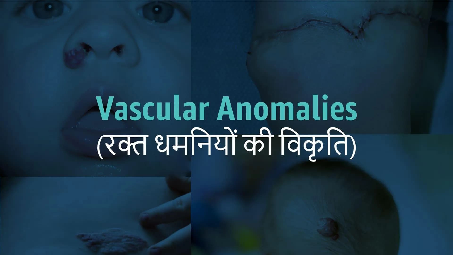 Vascular Anomalies (Malformation of Blood Vessels)