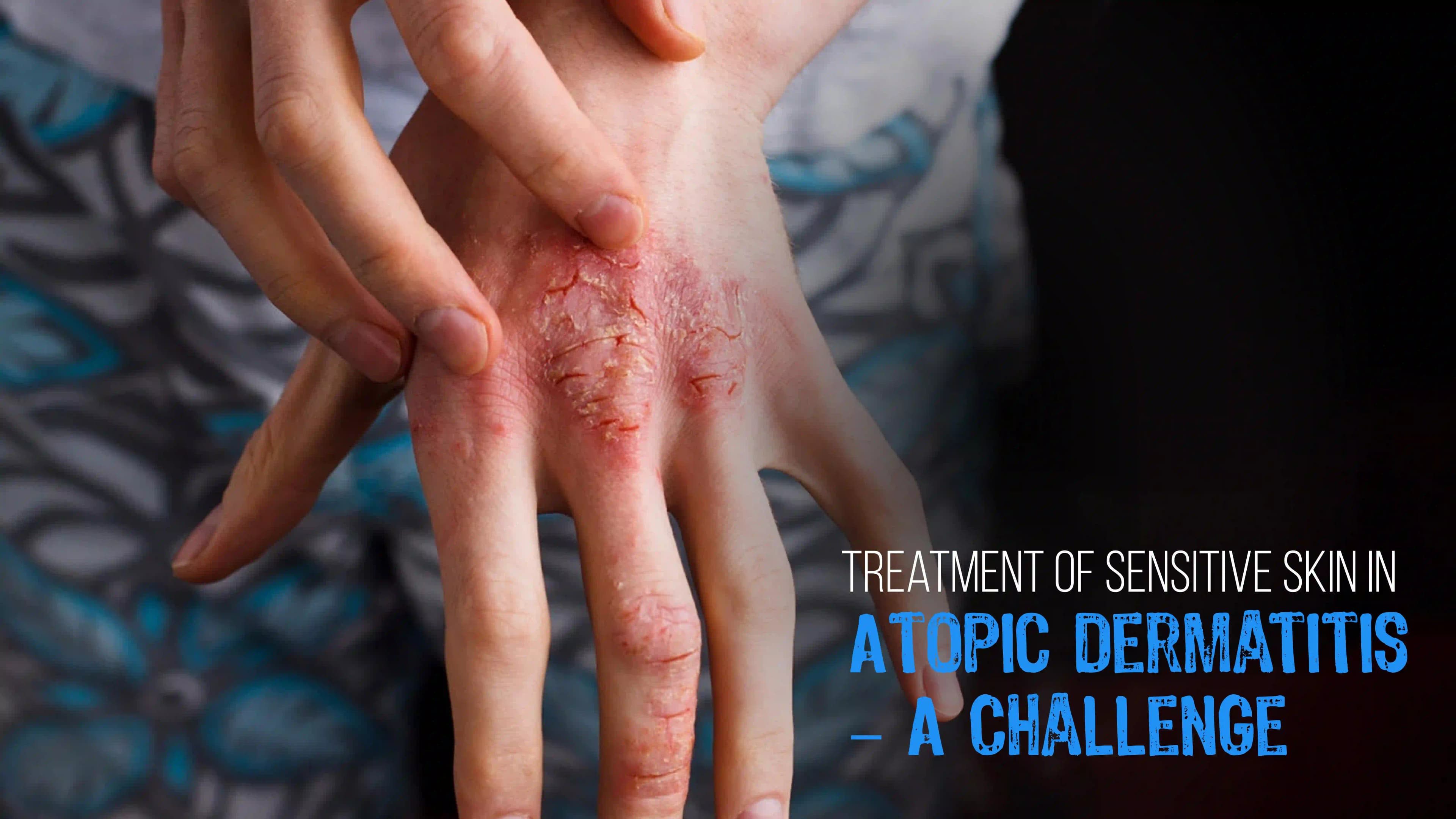 Treatment of Sensitive Skin in Atopic Dermatitis - A Challenge