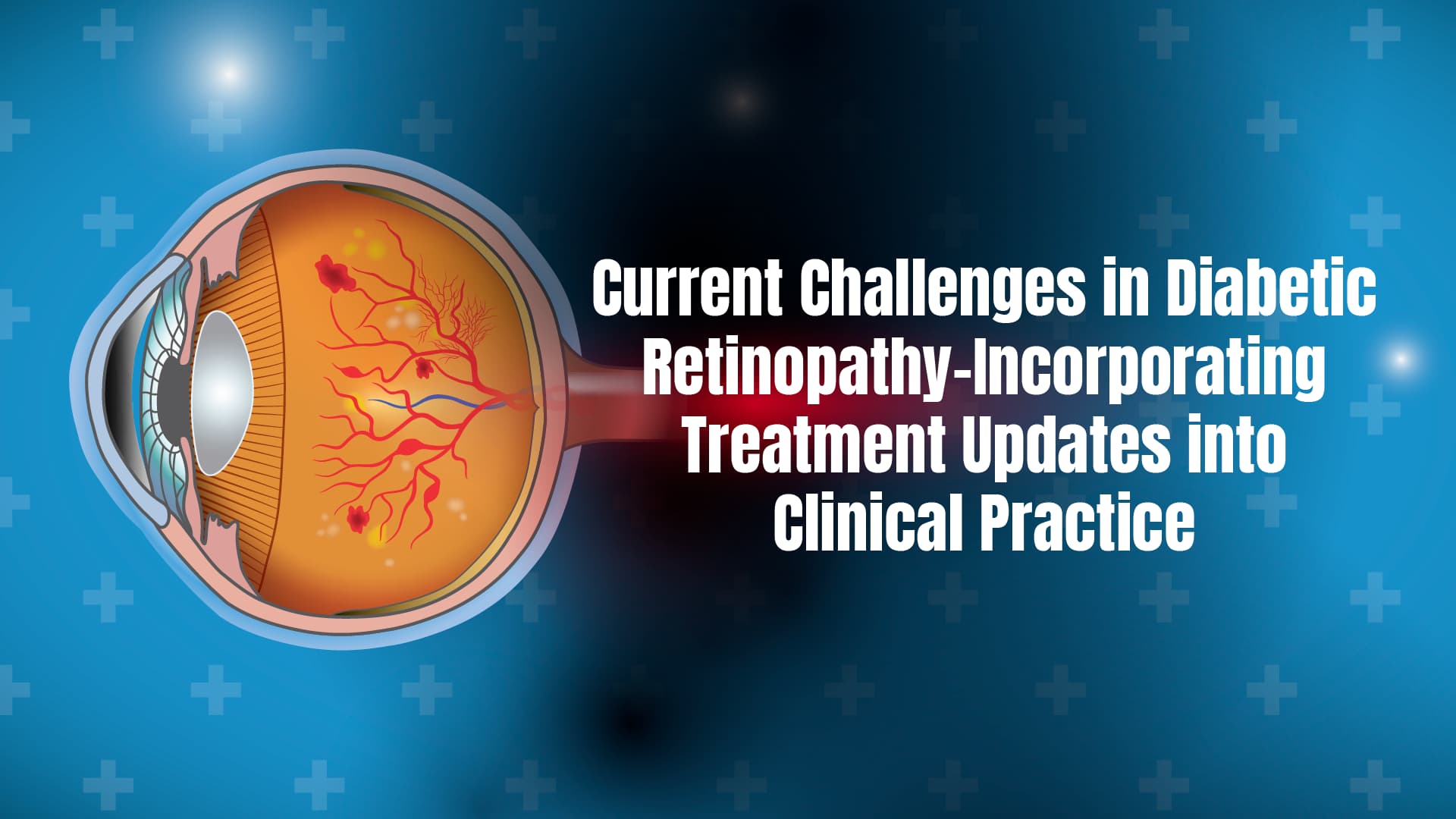 Current Challenges in Diabetic Retinopathy-Incorporating Treatment Updates into Clinical Practice