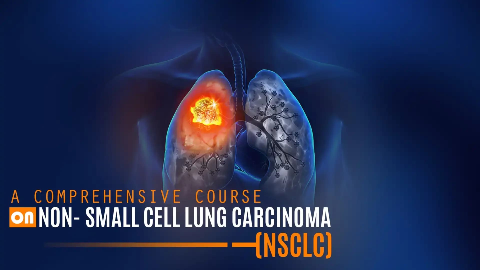 A Comprehensive Course on Non- Small Cell Lung Carcinoma (NSCLC)