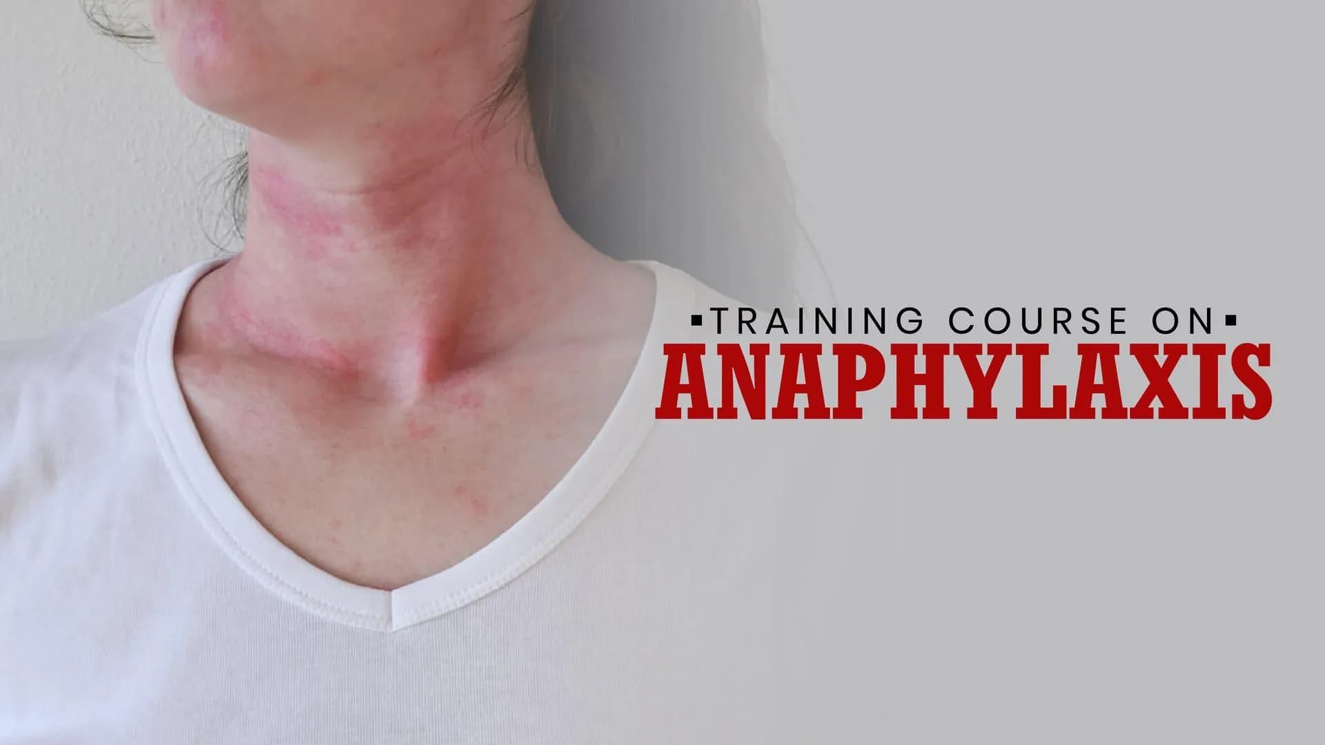 Training Course on Anaphylaxis